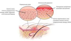 atopicheskij-dermatit-u-vzroslyh-lechenie