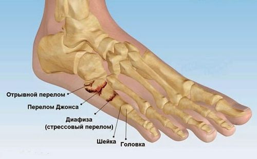 перелом кости пальца ноги