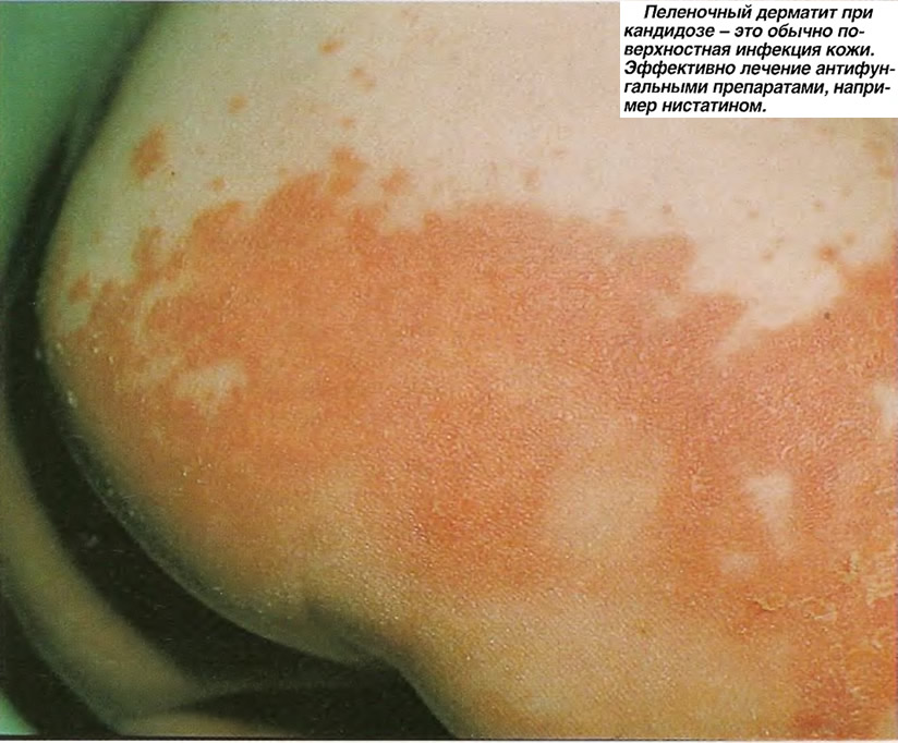 pelenochnyj-dermatit
