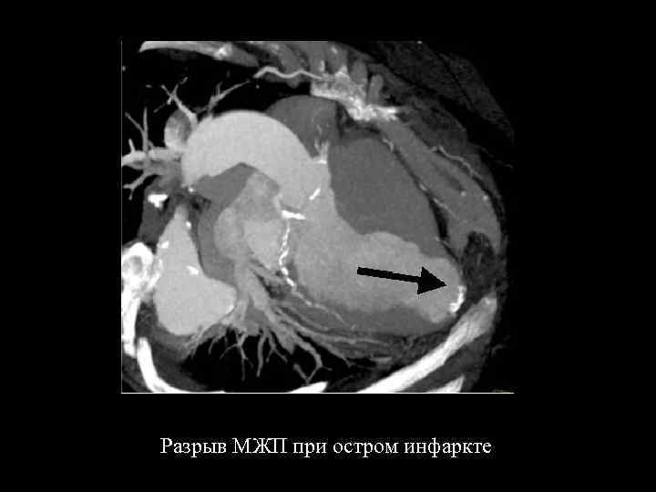 Разрыв межжелудочковой перегородки после инфаркта миокарда: патофизиология, прогноз
