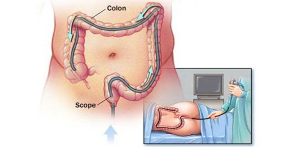 Противопоказания колоноскопии кишечника
