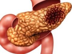Панкреонекроз поджелудочной железы – смертельно опасное состояние