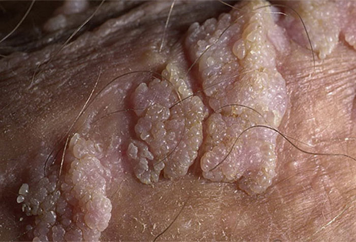 Причины, симптомы и методы лечения кондиломы на коже (код по МКБ 10)