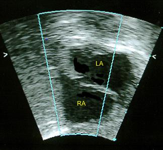Эта двумерная эхокардиограмма у младенца (вид подреберья с длинной осью) показывает открытое овальное отверстие. Правое предсердие и левое предсердие.