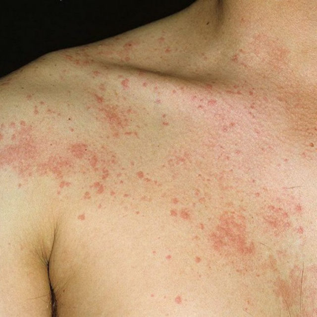 При аллергической реакции на компоненты могут наблюдаться кожные высыпания, в этом случае использование препарата нужно прекратить