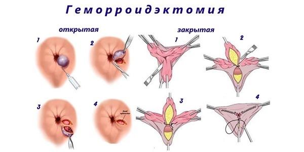 Геморроидэктомия: плюсы и минусы операции