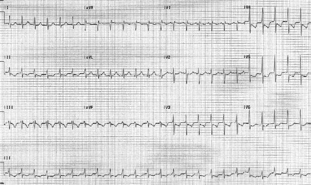 Предсердная тахикардия. Частота сердечных сокращений пациента составляет 151 уд / мин. P-волны вертикальны в отведении V1.