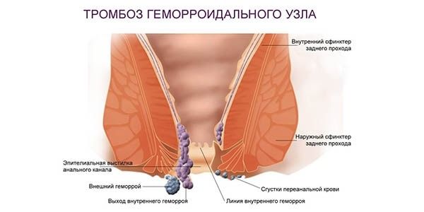 Тромбоз геморроидального узла: симптомы и лечение