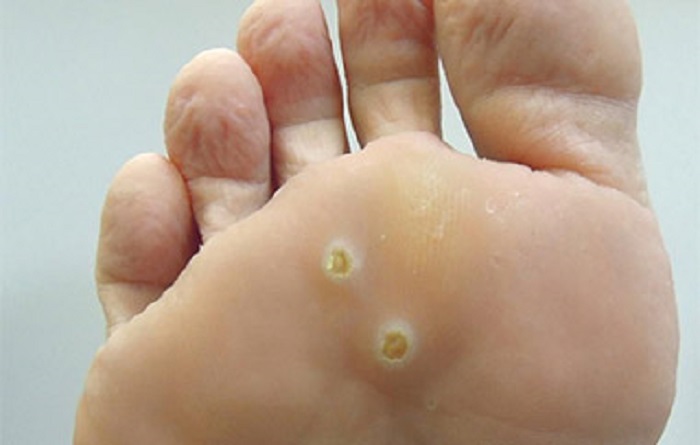 Какую опасность таят в себе бородавки на ногах: диагностика и лечение