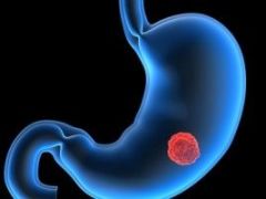 Тубулярная аденома желудка: как вылечить и не допустить повторного развития полипа?