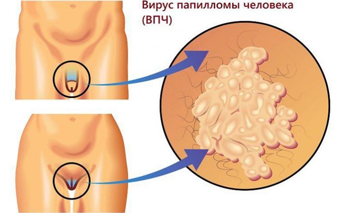 Папилломавирус у мужчин и женщин: чем может быть опасен вирус папилломы человека?