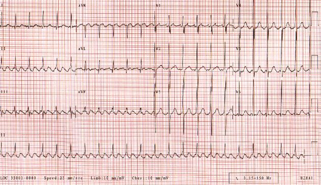 Трепетание предсердий. Частота сердечных сокращений у пациента составляет приблизительно 135 уд / мин при проводимости 2: 1. Обратите внимание на пилообразную структуру, образованную волнами флаттера.