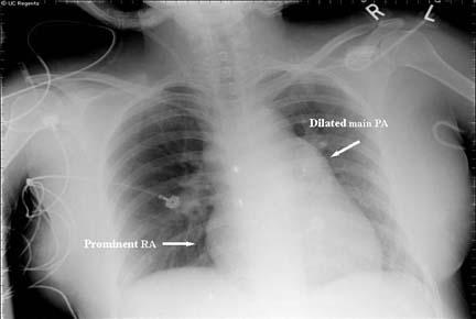 На этой рентгенограмме показана увеличенная дилатация правого сердца и легочной артерии у 24-летней женщины с неограниченным открытым артериальным протоком (КПК) и синдромом Эйзенменгера.