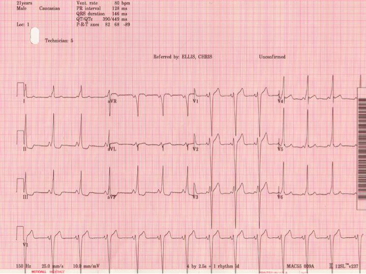 Классическая электрокардиограмма Wolff-Parkinson-White с коротким интервалом PR, QRS> 120 мс и дельта-волной