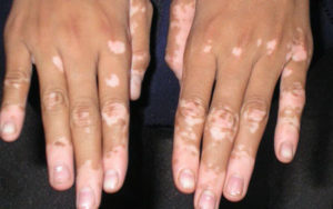 vitiligo-foto