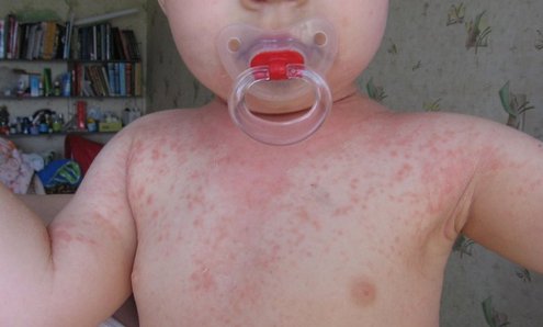 красные пятна и температура у ребенка на теле