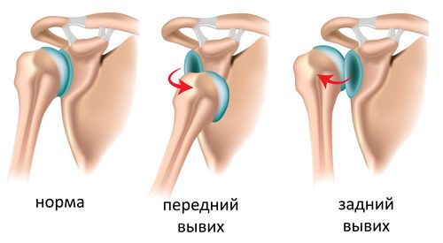Классификация травмы плеча