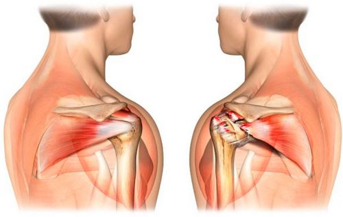 Растяжение связок плечевого сустава – методы терапии