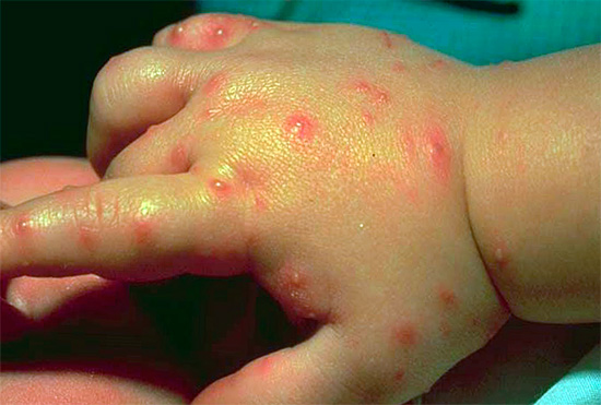 красные пятна и температура у ребенка на теле