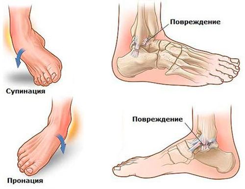 Причины и виды растяжения ноги
