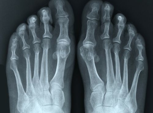 снимок костей ног