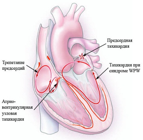 тахикардия сердца