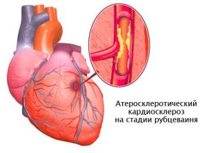 Виды кардиосклероза
