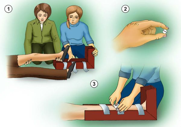 Первая помощь при переломе ноги