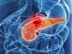 Цистаденокарцинома поджелудочной железы: особенности течения и прогноз заболевания
