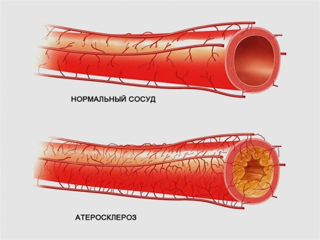 Профилактика и лечение атеросклероза, атеросклероз сосудов нижних конечностей