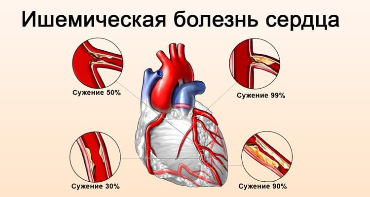 Ишемическая болезнь сердца (ИБС): что такое, симптомы, причины, лечение