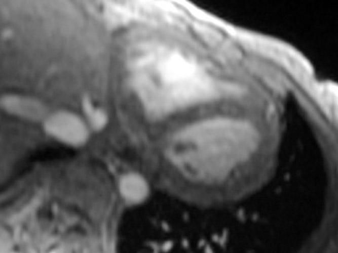 Ограничительная кардиомиопатия. Осевое двойное инверсионно-восстановительное магнитно-резонансное изображение сердца у 30-летней женщины с саркоидозом демонстрирует нормальный перикард.