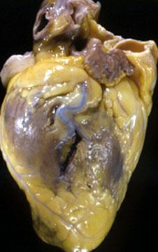 Фотография сердца 43-летнего мужчины, демонстрирующая место колотой раны над боковой свободной стенкой левого желудочка (показана в виде вертикального разрыва).