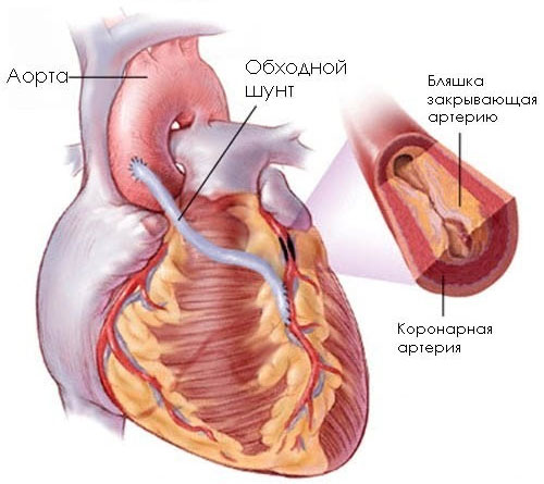 Что такое кардиосклероз сердца, симптомы, причины, диагностика, лечение