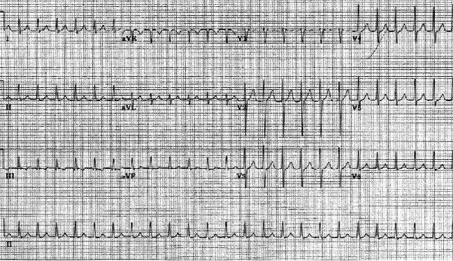 Атриовентрикулярная узловая реентеративная тахикардия. Частота сердечных сокращений пациента составляет приблизительно 146 уд / мин с нормальной осью. Обратите внимание на волны псевдо S в выводах II, III и aVF. Также обратите внимание на псевдо-волны R 'в V1 и aVR. Эти отклонения представляют собой ретроградную активацию предсердий.
