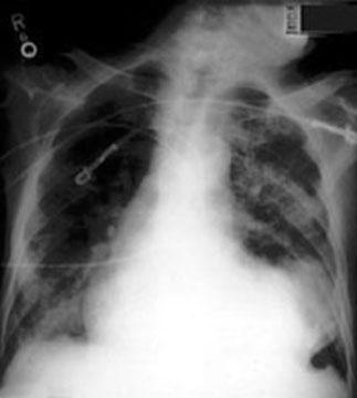 Рентгенограмма грудной клетки в задне-передней проекции, показывающая большой псевдоаневризм, проявляющийся в виде выпуклости на левой границе сердца.