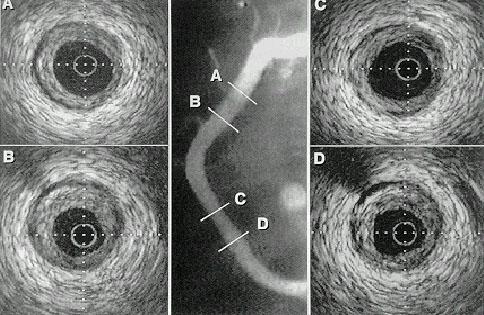 Пример изображения внутрисосудистой ультрасонографии при чрескожной транслюминальной коронарной ангиопластике