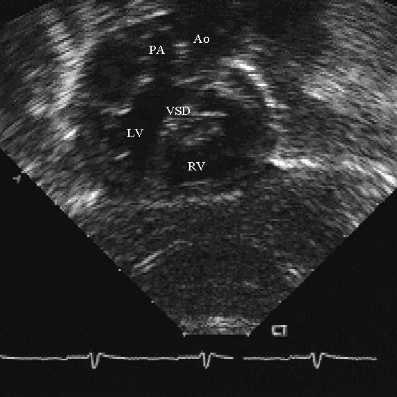 Вид подреберья у 1-летнего ребенка с L-транспозицией магистральных артерий, стенозом клапанного и субклапанного пульмонального клапана и умеренным выходным вентрикулосептальным дефектом