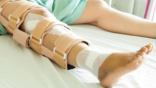 Перелом коленной чашечки – лечение, восстановление