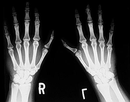 Задне-передняя рентгенограмма рук пациента с синдромом Холт-Орама. Дистальная фаланга левого большого пальца гипопластична. Кистевые кости обеих рук являются ненормальными, но аномалии на левой стороне больше, чем на правой стороне. Аномалии лучевых лучей левой верхней конечности часто больше, чем на правой стороне.