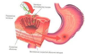 Как вылечить гастрит желудка: причины болезни