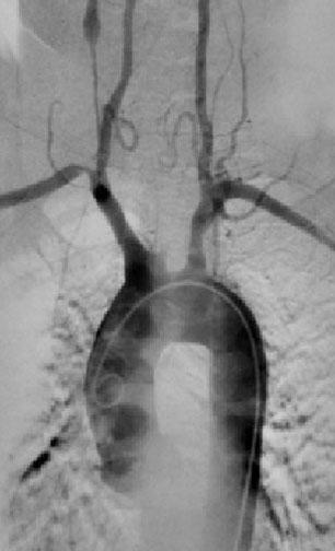 Полная окклюзия левой общей сонной артерии у 48-летней женщины с болезнью Такаясу. 