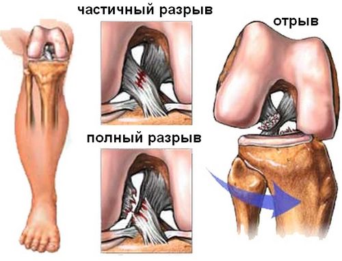Виды повреждения связок колена