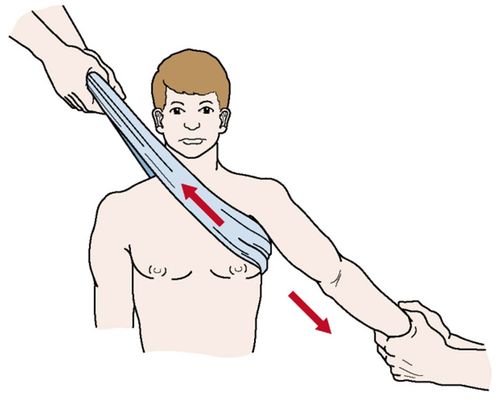 Процедура вправления плеча