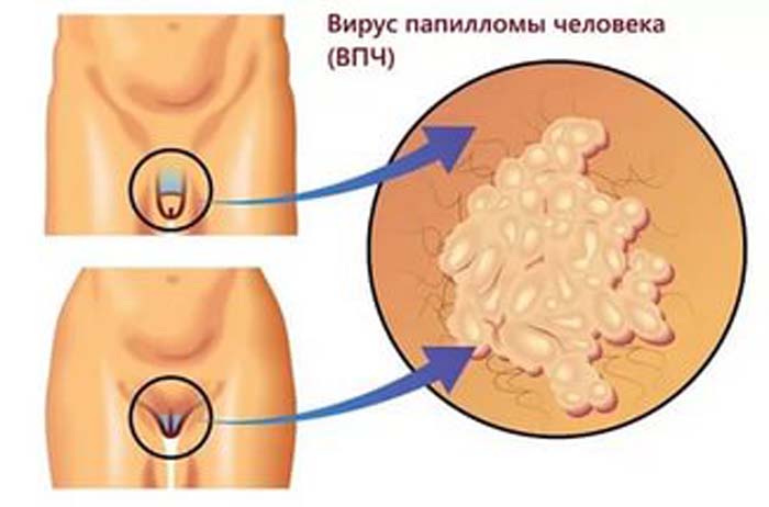 Лечение ВПЧ 18 типа у женщин: особенности инфекции, подробное описание и лечение папилломавируса