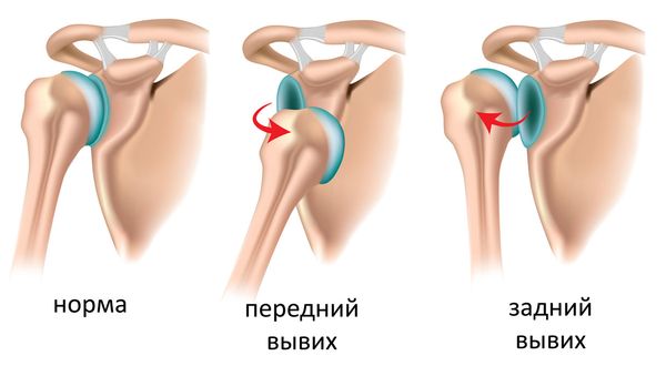 Пример переднего и заднего вывиха плеча