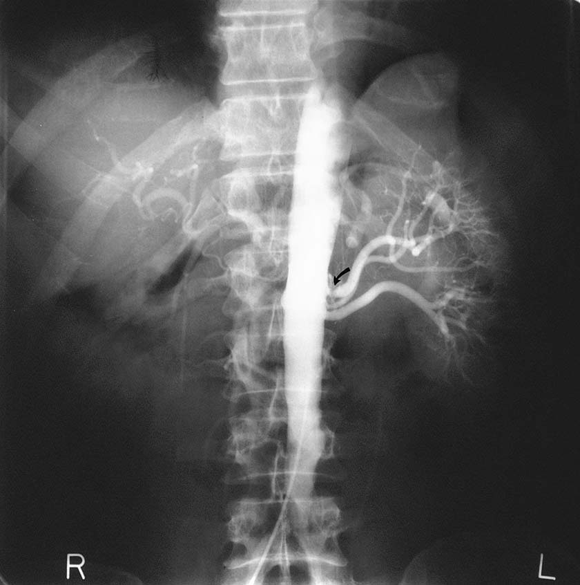 Стеноз почечной артерии / реноваскулярная гипертензия. Вторичная аортограмма у 32-летнего мужчины с семейной гиперхолестеринемией и трудно контролируемой гипертензией. Рентгенограмма показывает полную окклюзию правой почечной артерии и выраженный стеноз левой почечной артерии (стрелка).
