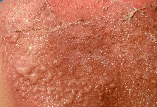 последствия лучевого ожога кожи