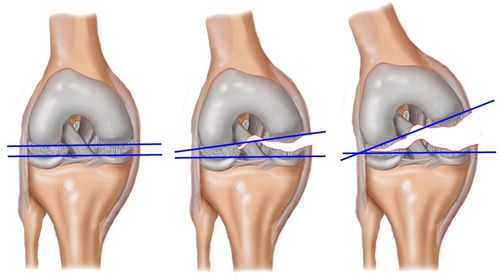 Типы повреждения связок коленного сустава