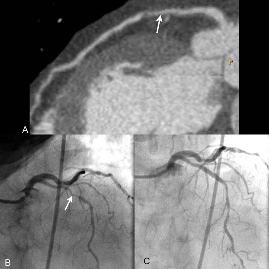 КТ-ангиография и катетеризация: Мультипланарная реконструкция (MPR) КТ-изображение (A) демонстрирует тяжелый проксимальный стеноз левой нисходящей (LAD) артерии (стрелка), также продемонстрированный при катетеризации сердца (B) (стрелка).